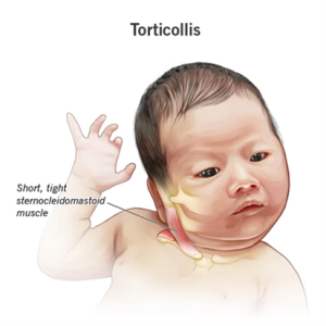 https://my.clevelandclinic.org/health/diseases/22430-torticollis
