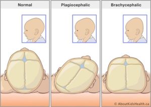 Photo from aboutkidshealth.cahttps://www.aboutkidshealth.ca/plagiocephaly 
